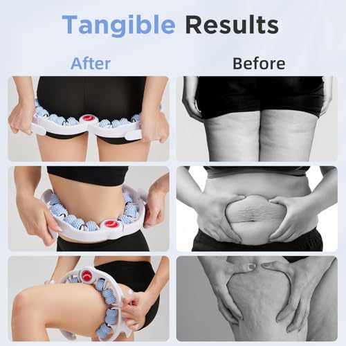 Cellulite Massage Tool, Anti-Cellulite Roller- Lymphatic Drainage Massager - Muscle Roller, Deep Fascia Massage, Dimpled Skin Removal, Legs/Thighs/Buttocks, Smooth Skin (14 Wheel - Blue) - color: 14 Wheel -White Blue